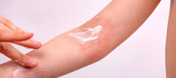 Application de crème sur une plaque sèche et rouge sur le bras, soulageant l'irritation cutanée.