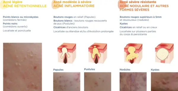 Schéma illustrant les différents types d'acné, des points blancs aux kystes, montrant l'évolution d'un bouton de puberté.