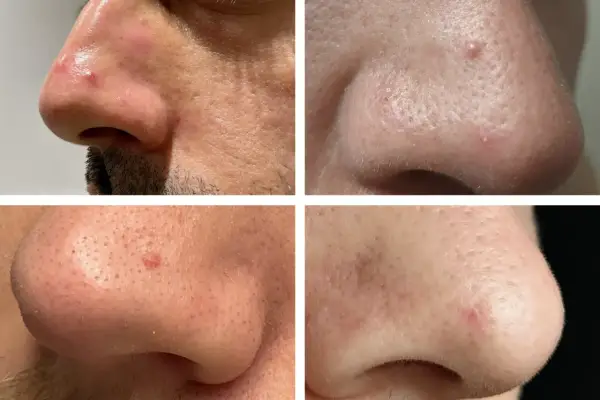 Gros plan sur le nez d'une personne, montrant des rougeurs et des petites lésions cutanées, possiblement un kyste sur le visage, nécessitant une attention médicale pour écarter tout risque de cancer.
