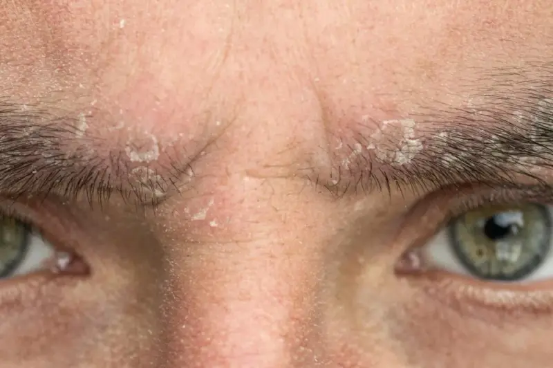 Gros plan sur un sourcil qui gratte et pèle, avec des squames blanches visibles sur la peau et entre les poils.